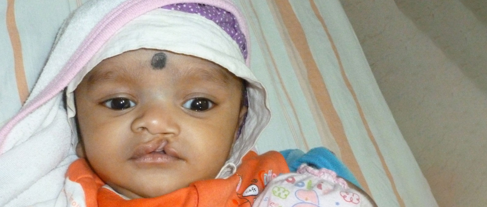 Cleft Lip & Palate Surgery